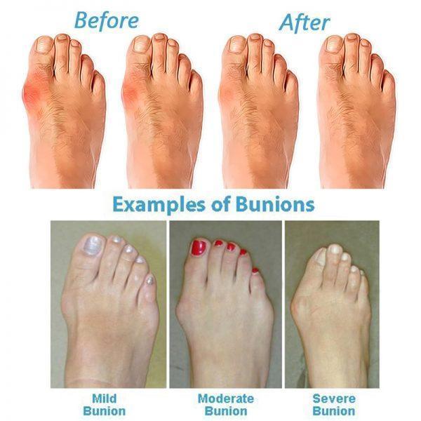 Orthopedic Toe Corrector Sandals