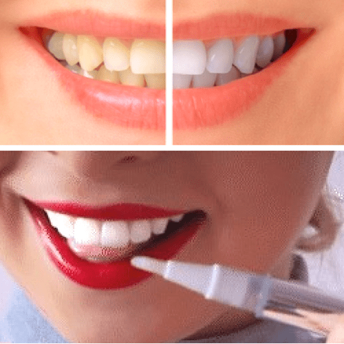 #1 Teeth Whitening Pen - Perfect Smile